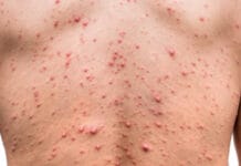 Salud activa protocolo ante detección de dos casos de viruela del mono