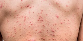 Salud activa protocolo ante detección de dos casos de viruela del mono