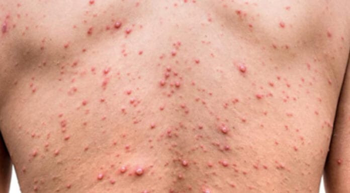 Salud activa protocolo ante detección de dos casos de viruela del mono